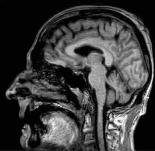 遅発性Pompe病でのBright tongue signについて｜神経内科の論文学習