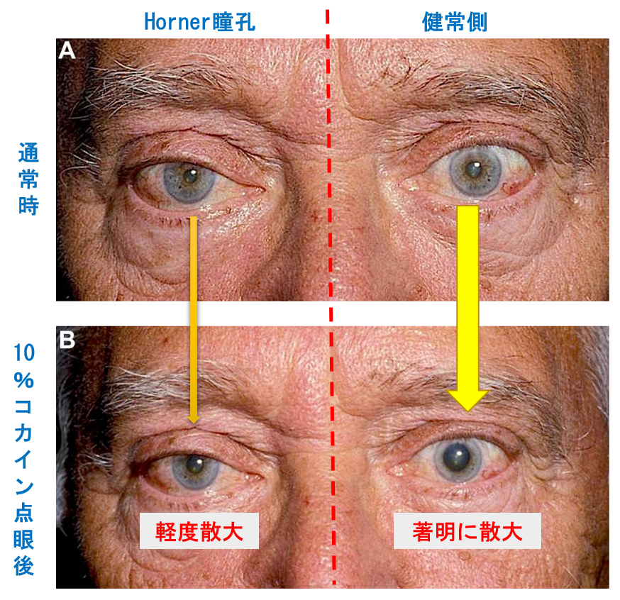 Horner症候群に関する総説：臨床的特徴～診断｜神経内科の論文学習