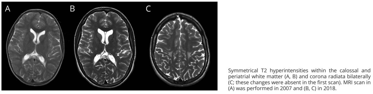 CMT以外でPes cavus(凹足)を呈した症例｜神経内科の論文学習
