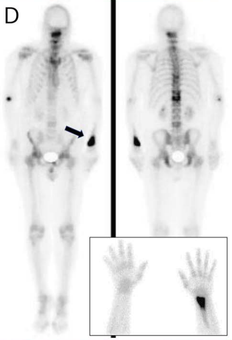 骨病変を伴うミオパチー(Clinical Reasoning)｜神経内科の論文学習