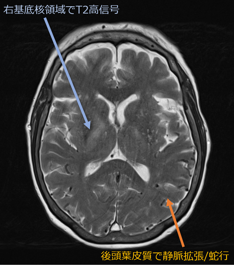 稀な原因による治療可能なパーキンソニズム|BMJ Pract Neurol