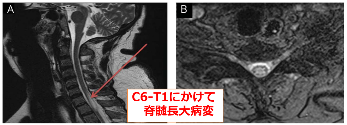 脊髄病変を伴った急速進行性のプリオン病｜神経内科の論文学習