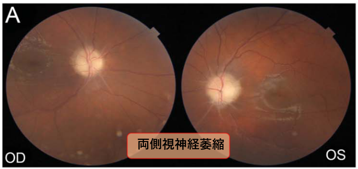 思春期発症の両側視力障害を呈した慢性無菌性髄膜炎｜神経内科の論文学習