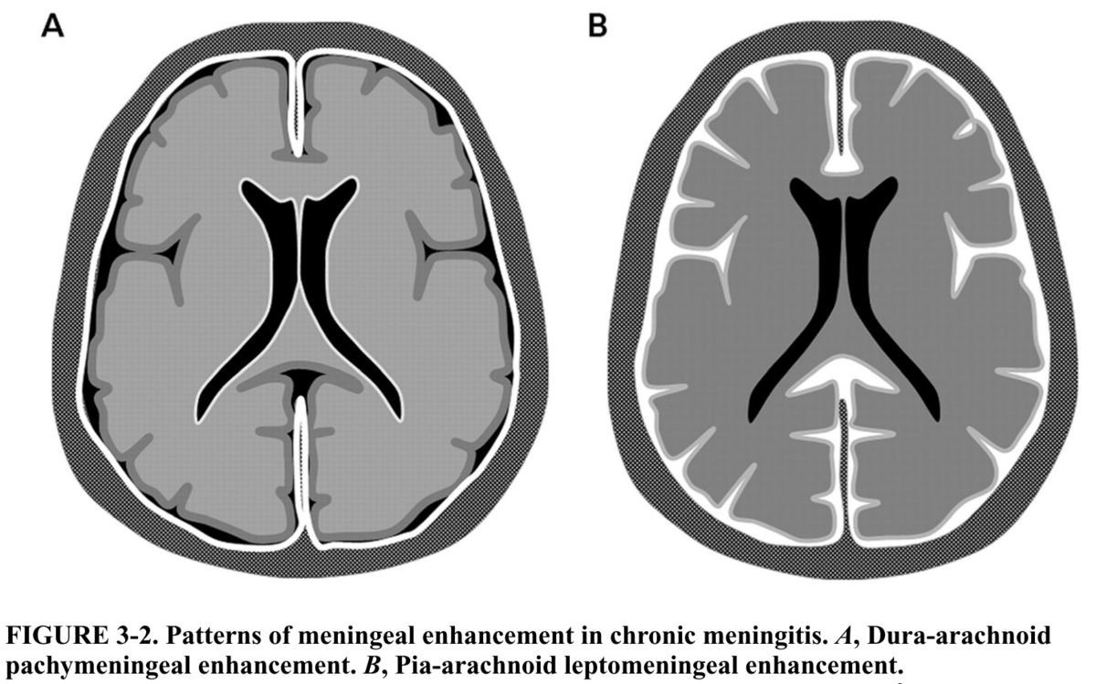 慢性髄膜炎のアプローチに関する備忘録｜神経内科の論文学習