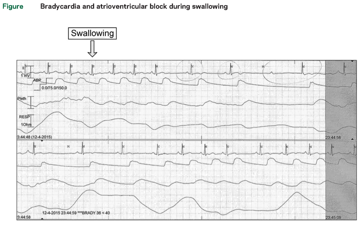 Clinical Reasoning:Heart to swallow (心臓から嚥下へ？？)｜神経内科の論文学習