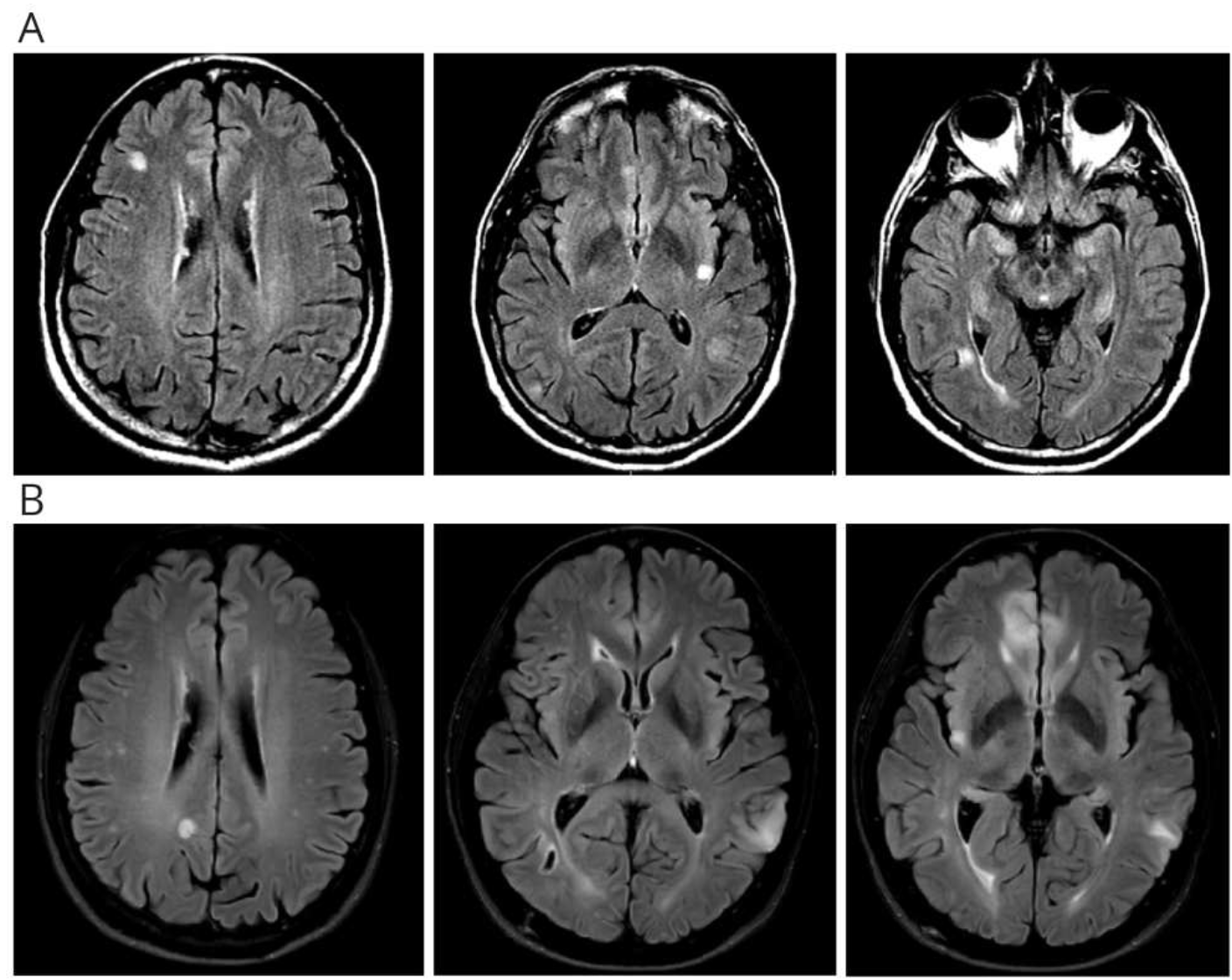 胸腺腫術後に精神症状,精神症状,多発脳病変を生じた症例